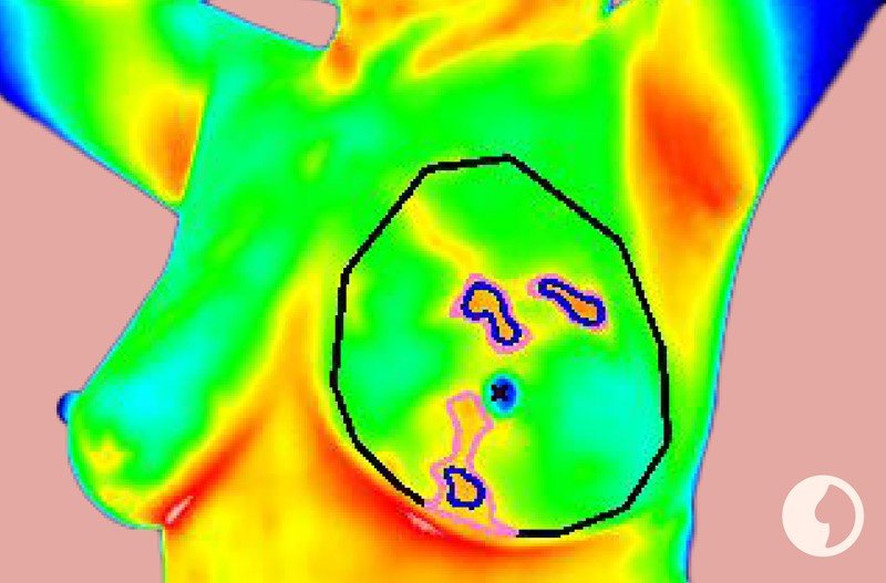 What is a Thermogram?